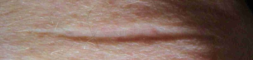 BOXCUTTERWOUND.jpg