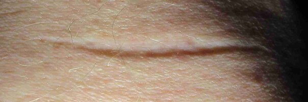 BOXCUTTERWOUND2.jpg
