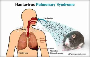 hantavirus-pulmonary-syndrome-799889034.jpg