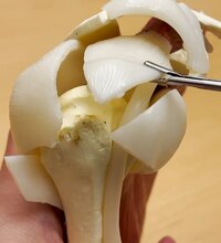 REVERSESHOULDERSURGERY2.jpg