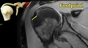 REVERSESHOULDERSURGERY5.jpg