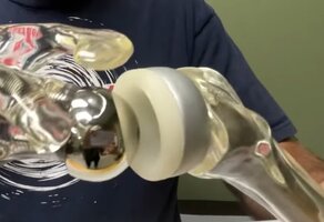 REVERSESHOULDERSURGERY10.jpg