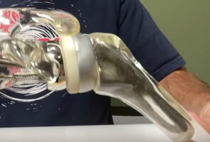 REVERSESHOULDERSURGERY11.jpg