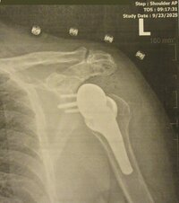 LEFTSHOULDERPOSTOPXRAY1.jpg