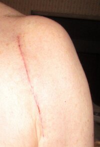 LEFTSHOULDERSCARLINE0.jpg