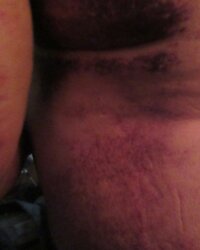 POSTOPBRUISING1.JPG