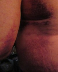 POSTOPBRUISING2.jpg
