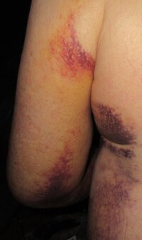 POSTOPBRUISING3.jpg