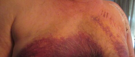 POSTOPBRUISING4.jpg