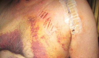 POSTOPBRUISING5.jpg