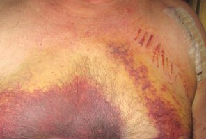 POSTOPBRUISING6.jpg
